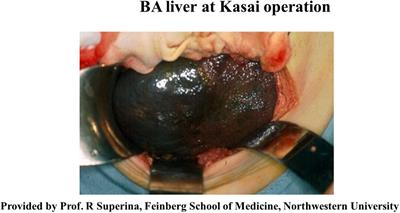 New insights in understanding biliary atresia from the perspectives on maternal microchimerism